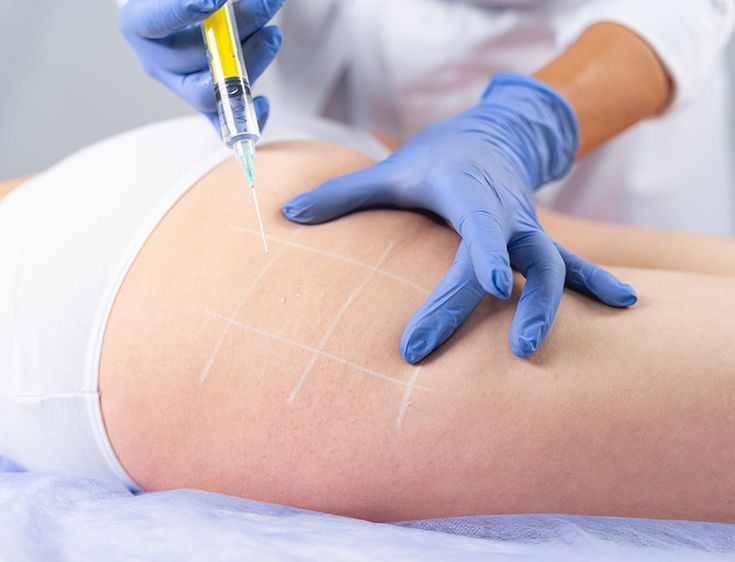 Mesoterapia Corporal